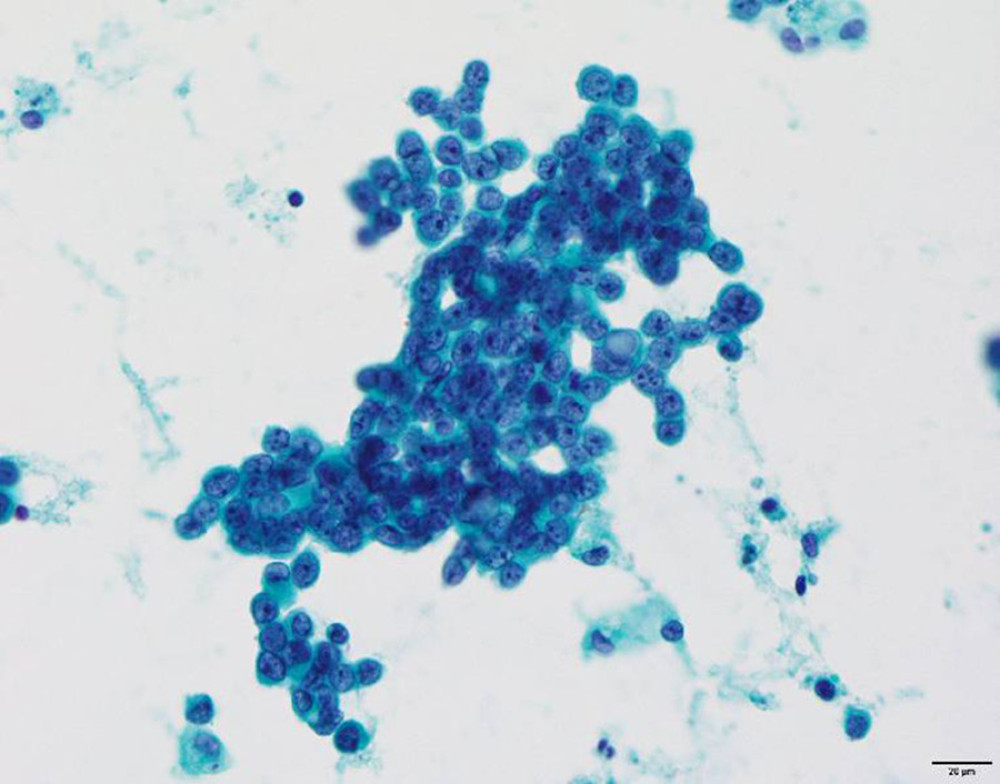 Cytological examination of the pericardial fluid – identification of adenocarcinoma cells.