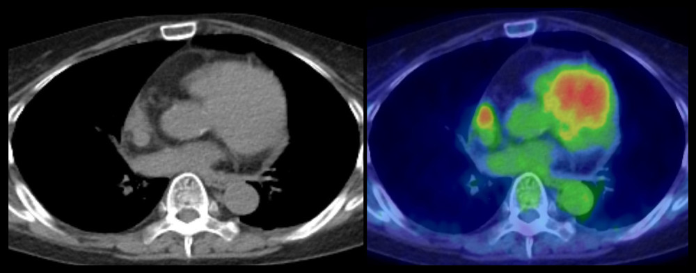 CT/FDG-PET – observation of pericardial thickening. There was FDG accumulation in the same site. FDG – fluorodeoxyglucose.