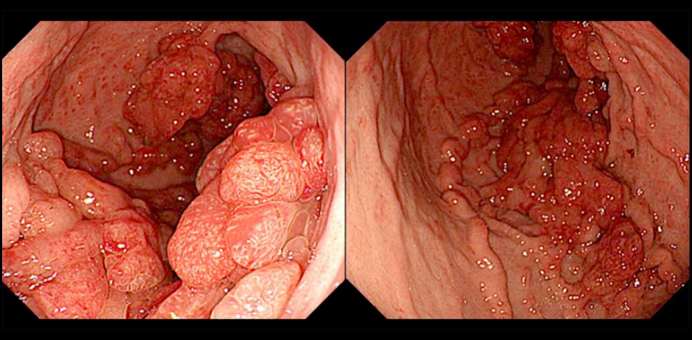 Multiple gastric polyps on esophagogastroduodenoscopy. There were dense, erythematous polyps in most parts of the stomach.