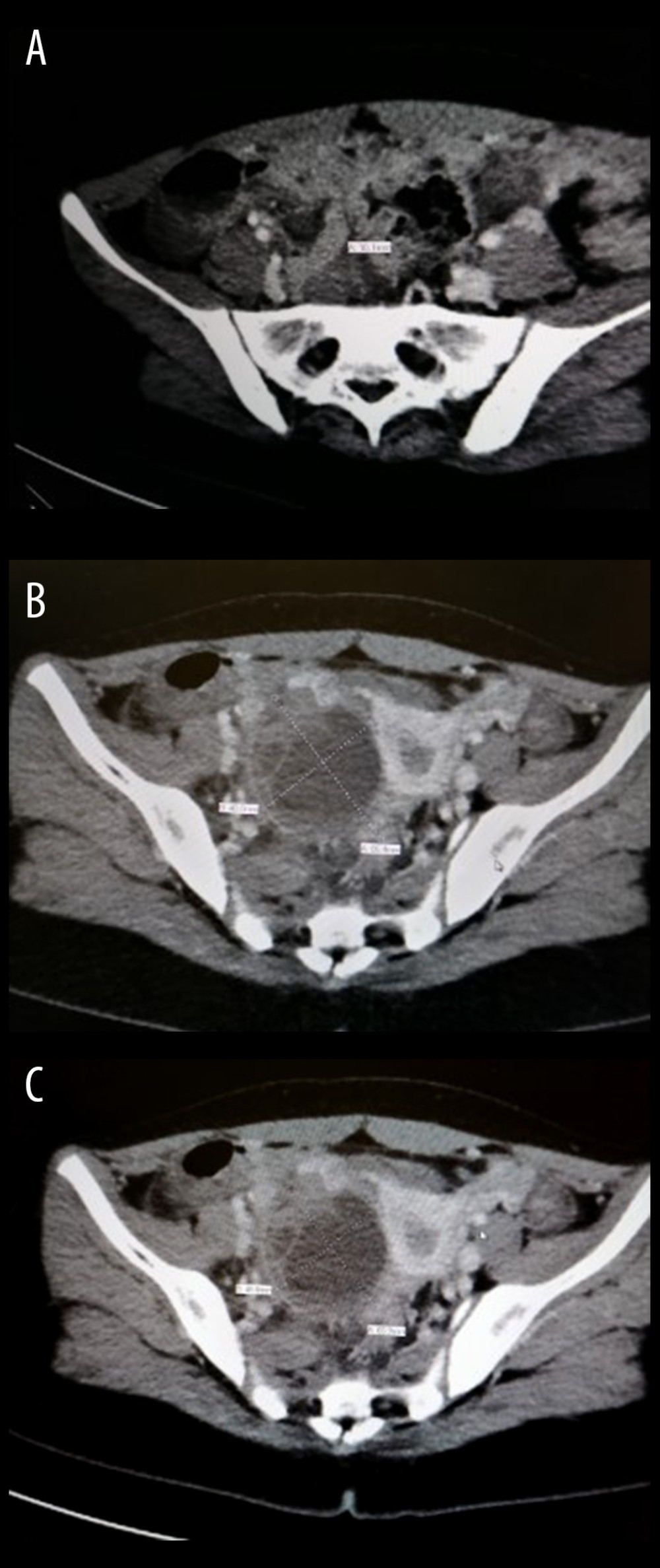 Coronal view of the abdominal and pelvic CT with intravenous contrast showing (A) an appendix with a thickened enhancing edematous wall in the right iliac fossa measuring about 10 mm in diameter; (B) moderate free fluid in the right iliac fossa, hepatorenal pouch, and pelvic region; (C) right adnexal cystic structure with septation, hyperdense component, and thickened wall, measuring about 6.5×4.8 cm.