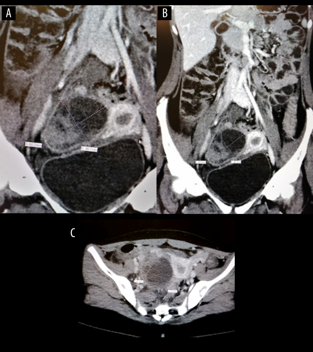 Axial view of the abdominal and pelvic CT with intravenous contrast showing (A) an appendix with thickened enhancing edematous wall in the rightiliac fossa measuring about 10 mm in diameter; (B) moderate free fluid in the right iliac fossa, hepatorenal pouch, and pelvic region; (C) right adnexal cystic structure with septation, hyperdense component, and thickened wall, measuring about 6.5×4.8 cm.