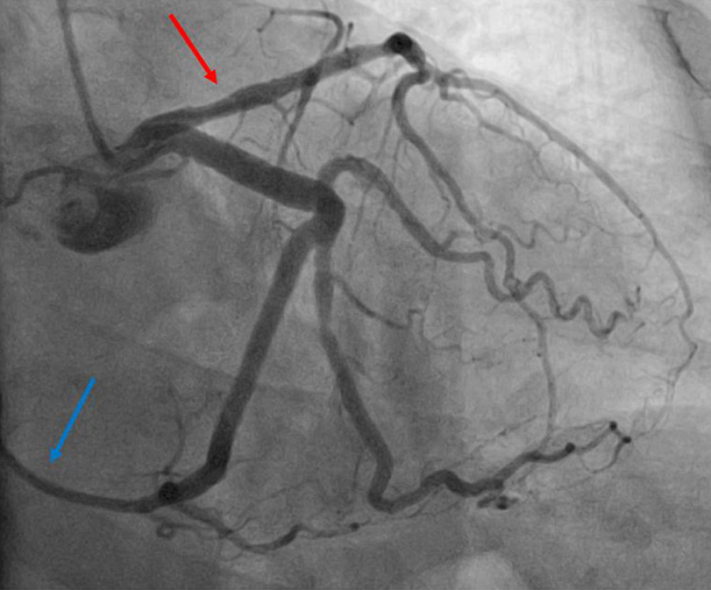 Coronary Angiography: Engagement of the left coronary artery via the right radial artery approach using a 6 French Judkins left (JL 3.5) catheter. The red arrow points toward the left anterior descending artery. The blue arrow points toward the left circumflex artery that supplies a territory of myocardium normally supplied by the right coronary artery. 14° right anterior oblique and 33° caudal view. Overall, there is evidence of mild epicardial coronary artery disease.