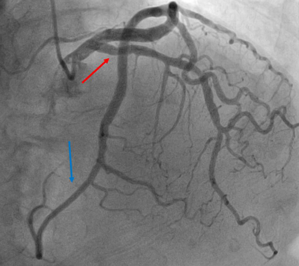 Coronary Angiography: Engagement of the left coronary artery via the right radial artery approach using a 6 French Judkins left (JL 3.5) catheter. The red arrow points toward the left anterior descending artery. The blue arrow points toward the left circumflex artery that supplies a territory of myocardium normally supplied by the right coronary artery. 18° right anterior oblique and 38° cranial view. Overall, there is evidence of mild epicardial coronary artery disease.