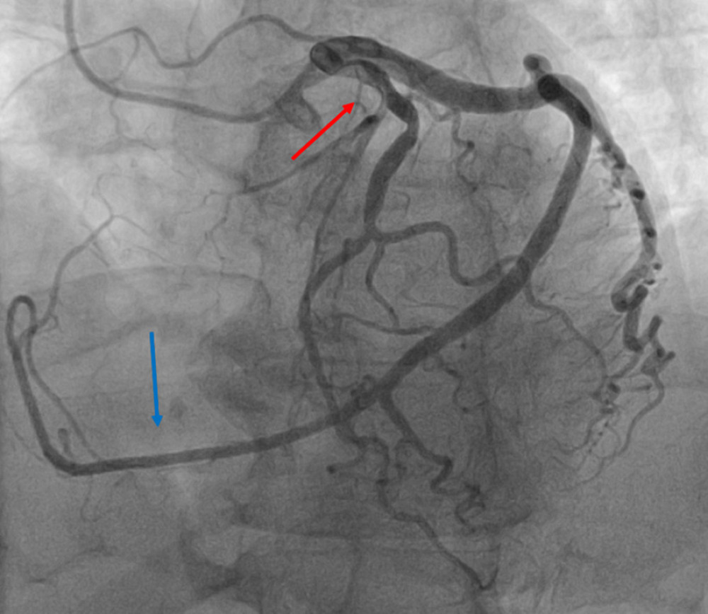 Coronary Angiography: Engagement of the left coronary artery via the right radial artery approach using a 6 French Judkins left (JL 3.5) catheter. The red arrow points toward the left anterior descending artery. The blue arrow points toward the left circumflex artery that supplies a territory of myocardium normally supplied by the right coronary artery. 24° left anterior oblique and 18° cranial view. Overall, there is evidence of mild epicardial coronary artery disease.