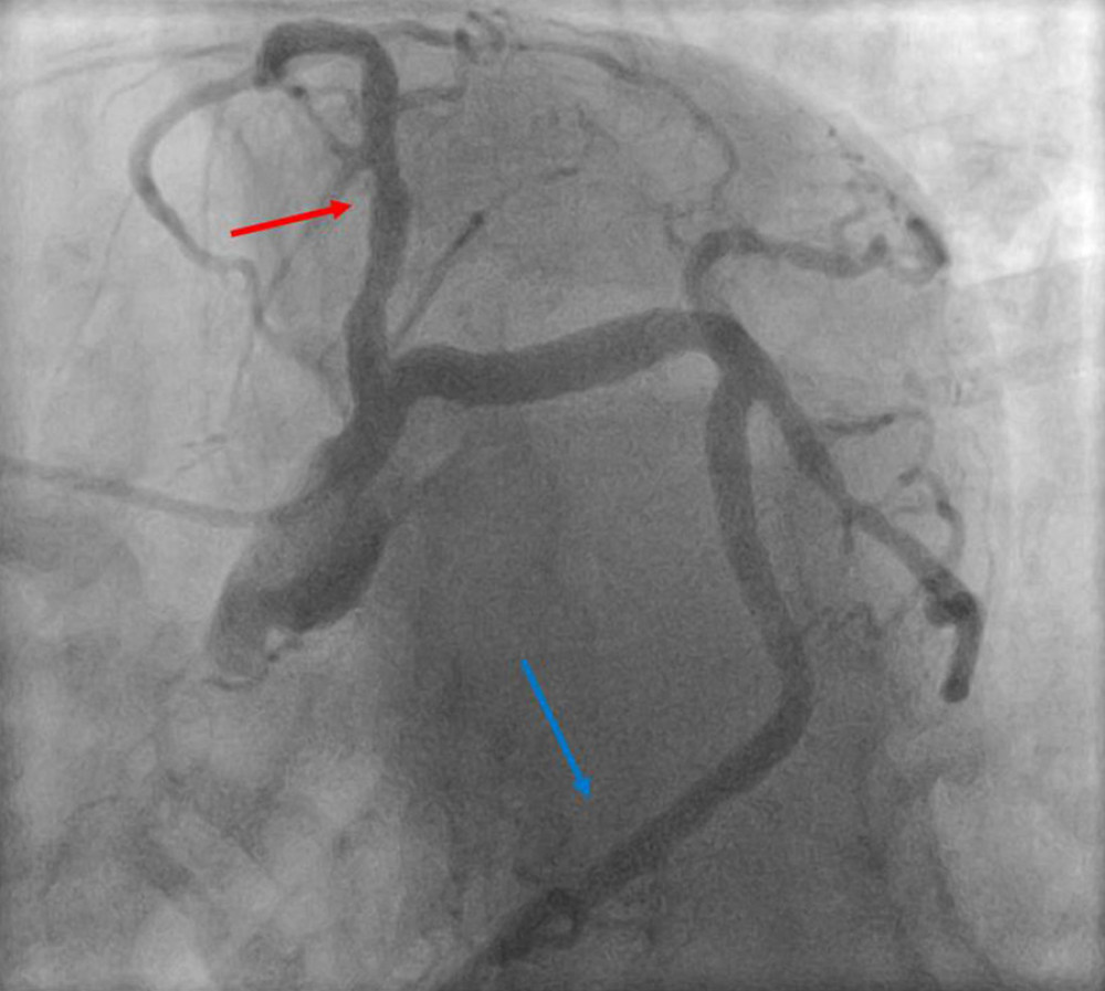 Coronary Angiography: Engagement of the left coronary artery via the right radial artery approach using a 6 French Judkins left (JL 3.5) catheter. The red arrow points toward the left anterior descending artery. The blue arrow points toward the left circumflex artery that supplies a territory of myocardium normally supplied by the right coronary artery. 41° left anterior oblique and 42° caudal view. Overall, there is evidence of mild epicardial coronary artery disease.