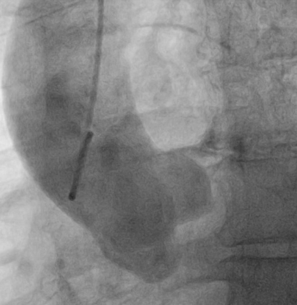 Ascending aortogram performed using a 6 French Pigtail catheter in the left anterior oblique view (30o). Aortography revealed absence of opacification of the right coronary artery confirming its absence.