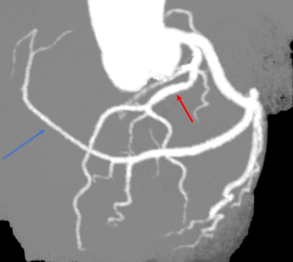 Coronary analysis obtained from coronary CTA. 30° left anterior oblique and 30° cranial view showing absence of a right coronary artery with the left circumflex supplying the distribution normally supplied by a native right coronary artery (blue arrow). The red arrow points to the left anterior descending artery.