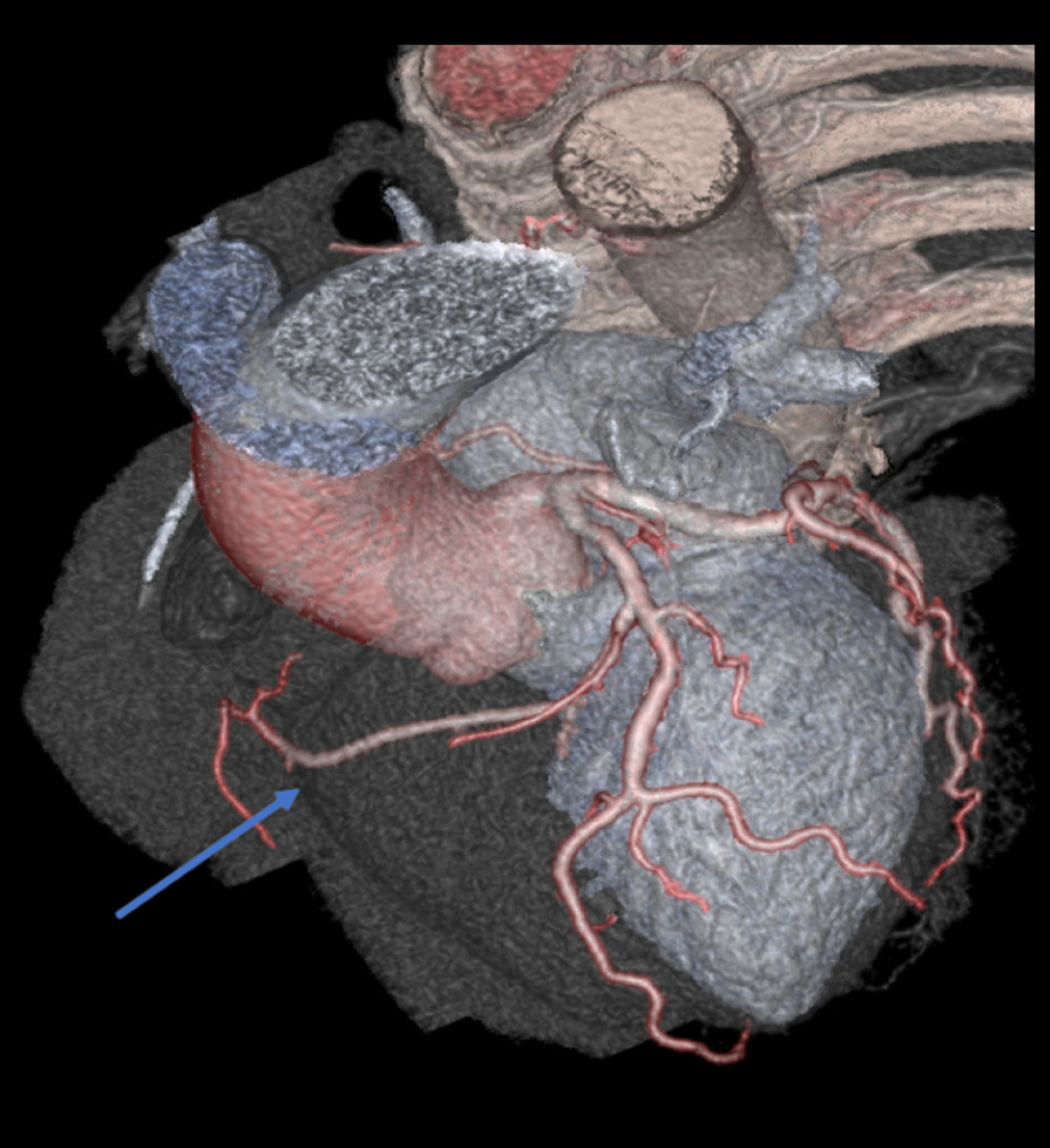 Volume-rendering image obtained from coronary CTA. 30° left anterior oblique and 60° cranial view showing absence of a right coronary artery with the left circumflex supplying the distribution normally supplied by a native right coronary artery (blue arrow).