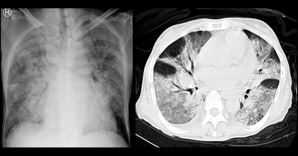 Chest X-ray and chest computed tomography (CT) findings on admission. Chest X-ray and chest CT images showing diffuse consolidation in both lung fields.