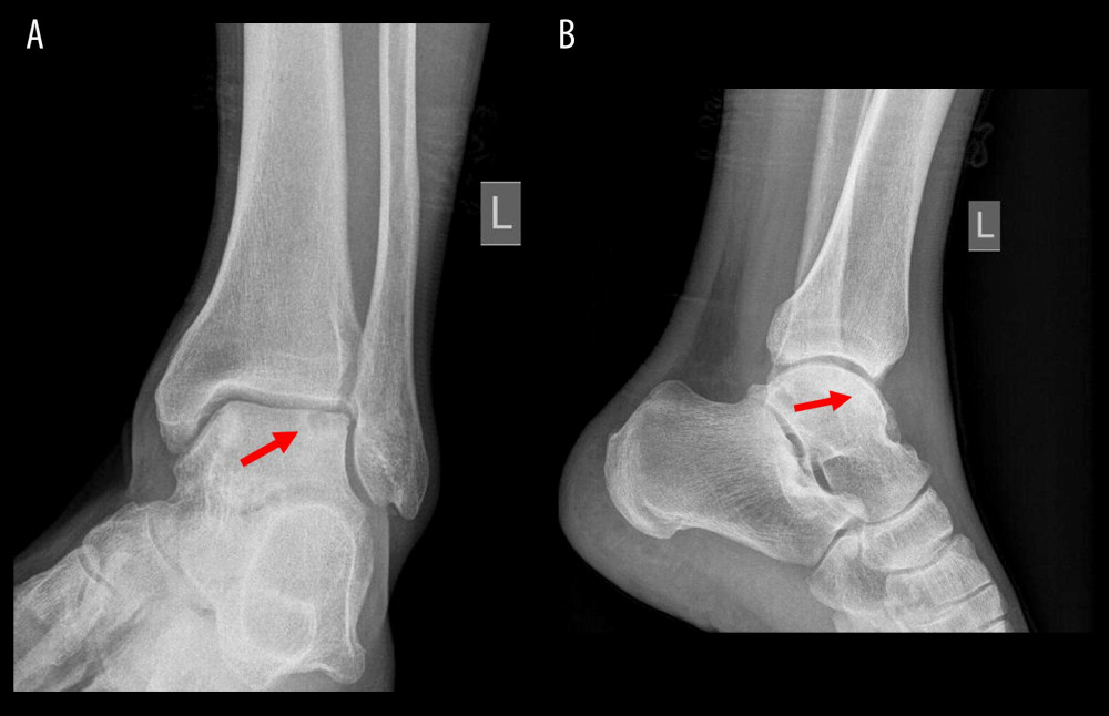 Anteroposterior (A) and lateral (B) radiographs of the left ankle revealing a radiolucent lesion (red arrow) in the lateral aspect of the talar dome.