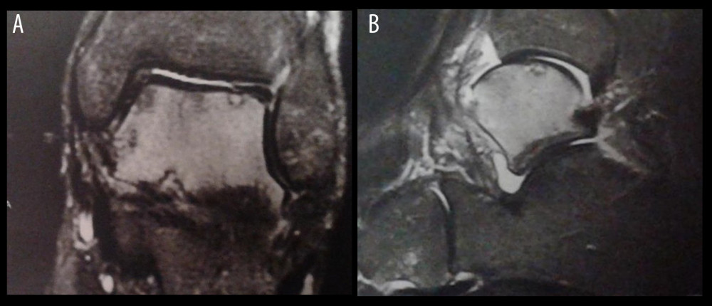 T2-weighted fat-saturated (A) coronal and (B) sagittal magnetic resonance images showing extensive bone marrow edema of the talus, subchondral lesions, and joint effusion.