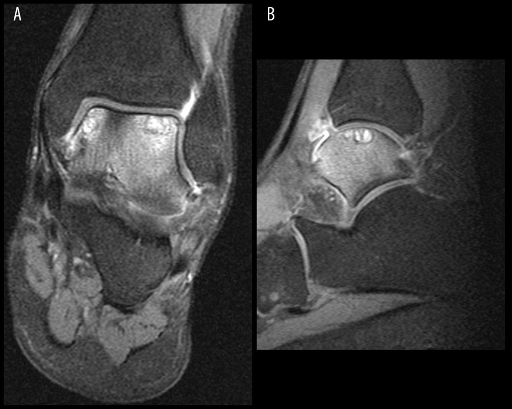 T1-weighted fat-saturated (A) coronal and (B) sagittal consecutive magnetic resonance images with gadolinium contrast 1 year postoperatively illustrating subchondral cystic lesions and extensive bone marrow edema of the talus and synovitis.