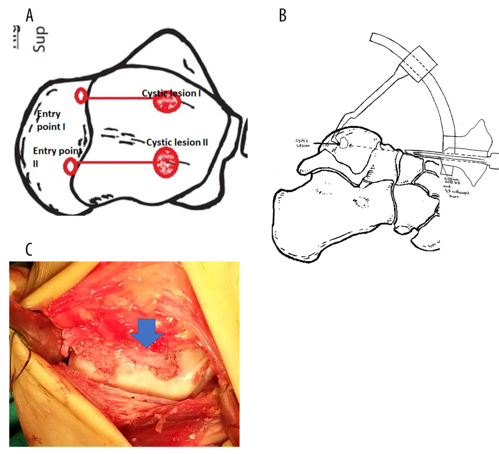 Schematic illustration of our surgical approach. (A) Two entry portals in the medial and lateral side of the talus were created to avoid branches of the anterior tibial artery. (B) Usage of the anterior cruciate ligament tibial guide. (C) Thick gelatinous fluid was extruded from both cysts (blue arrow).