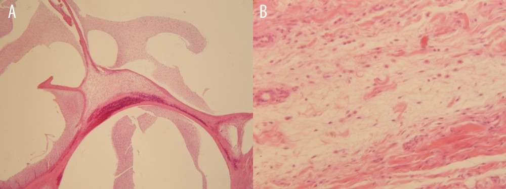 Photomicrographs at magnification of (A) ×20 and (B) ×40 depicting the loose connective tissue with myxoid change and the presence of blood vessels and a small number of lymphocytes.