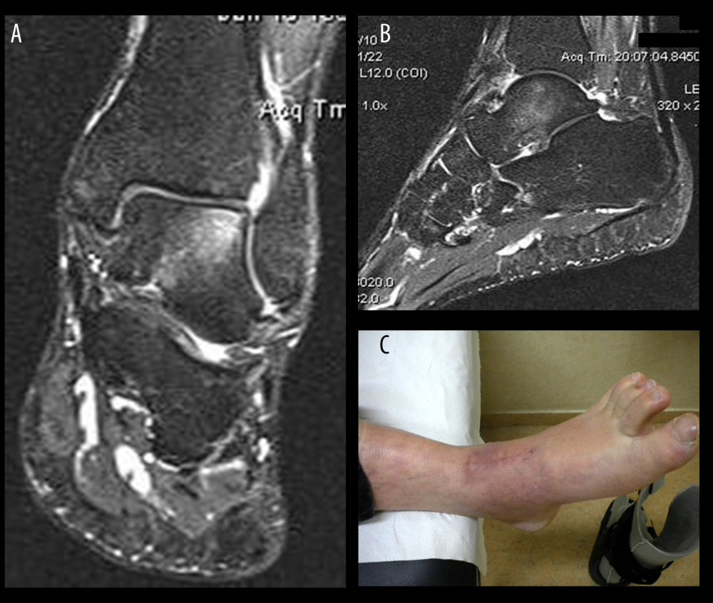 T1-weighted (A) coronal and (B) sagittal magnetic resonance images 2.5 years after surgery show mild bone marrow edema of the talus and only 1 nondiscrete small subchondral lesion. (C) Final clinical follow-up was excellent.