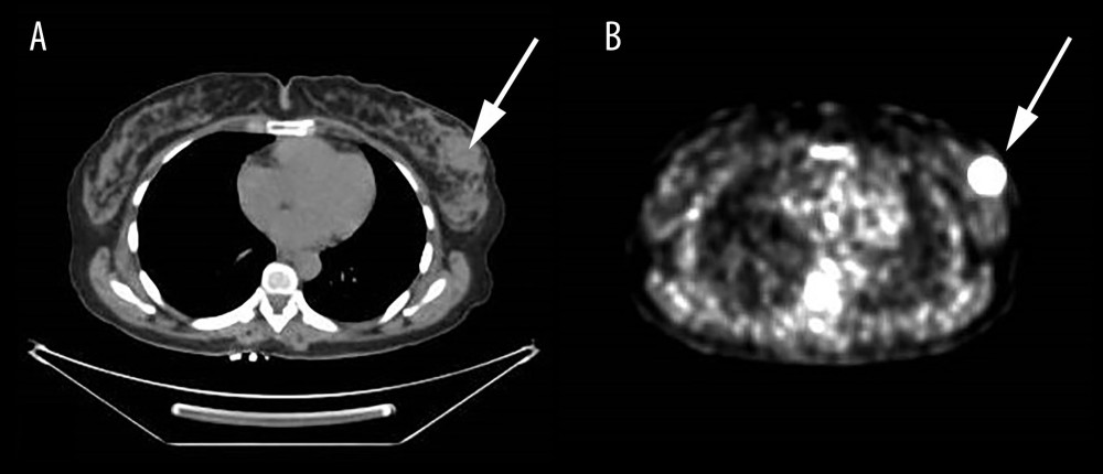 CT scan (A) and PET scan (B) showing the primary left breast mass lesion.