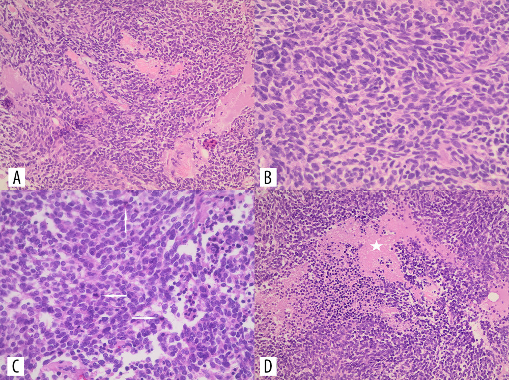 Core biopsy of breast lesion, showing small round-to-oval and short spindle-shaped cells arranged in sheets. These cells are characterized by high nuclear-to-cytoplasmic ratio, molded nuclei with salt-and-pepper chromatin, and no distinct nucleoli (A, B. Hematoxylin and eosin-stained sections, 200× and 400× total magnifications, respectively). High-grade malignancy is evidenced by frequent mitoses (C – highlighted by arrows) and areas of necrosis (D – highlighted by asterisk) – (C, D: Hematoxylin and eosin-stained sections, 400× total magnification).