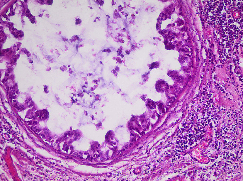 Ductal carcinoma in situ, micropapillary growth pattern, and a nuclear grade best assigned as low to intermediate (Hematoxylin & eosin-stained sections, 400× total magnification).
