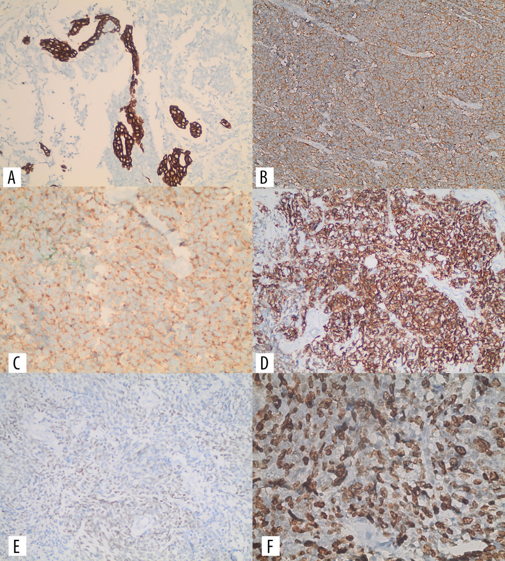 Immunohistochemical stains of the left breast tumor. A. The tumor shows patchy but strong immunoreactivity for CK7 (200× total magnifications). B. Synaptophysin marker with diffuse and moderate positivity (200× total magnifications). C. Chromogranin marker with diffuse and weak positivity (400× total magnification). D. CD56 marker with diffuse and strong positivity (400× total magnification). E. Focal and weak positivity for TTF1 marker (200× total magnification). F. Ki67 proliferation index estimated to be more than 60% in tumor cells (400× total magnification).