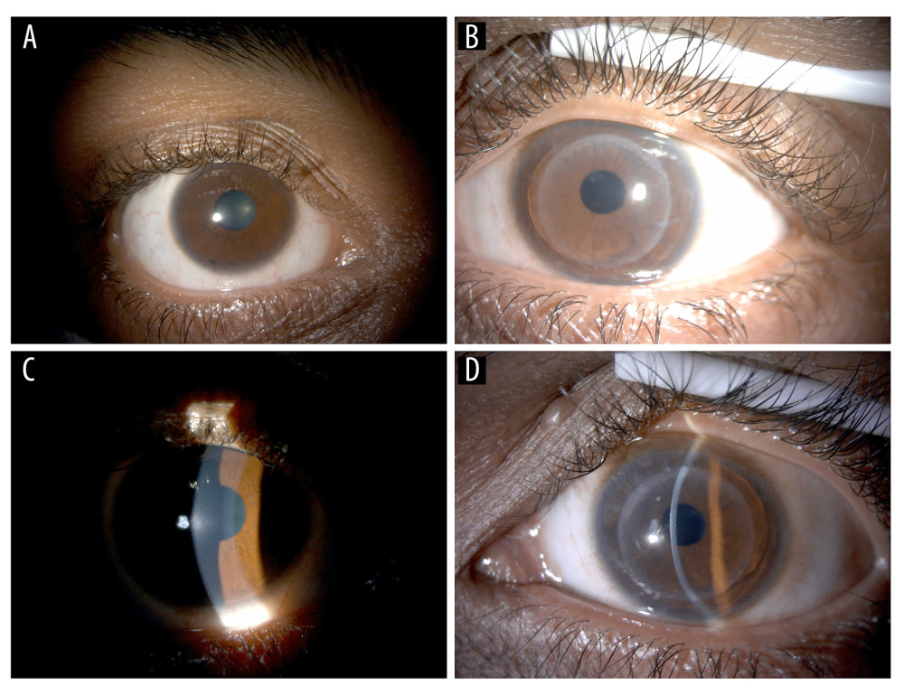 Biomicroscopic slit lamp photos: (A) Right eye with diffused illumination. (B) With the slit beam, the right eye showed advanced keratoconus with central corneal scarring. (C) Left eye with diffused illumination. (D) With the slit beam, the left eye showed a clear sutureless corneal graft with no signs of rejection.