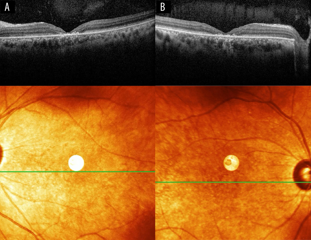 Ocular coherence tomography of the left eye (A) and right eye (B) with corresponding en face infrared images showed foveal hyperreflectivity with inverse shadowing indicating foveal atrophy in both eyes due to the loss of photoreceptors.
