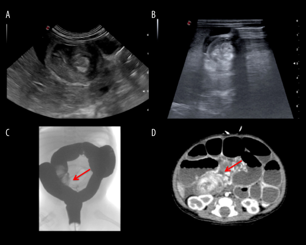 (A, B) Abdominal ultrasound showing a “doughnut sign” typical of ileocecal intussusception. (C) Rectal barium contrast enema with the liquid contrast identifying a minus image localized in the right inferior abdominal quadrant, suggesting an ileocecal intussusception. (D) Abdominal CT scan showing persistent intussusception.