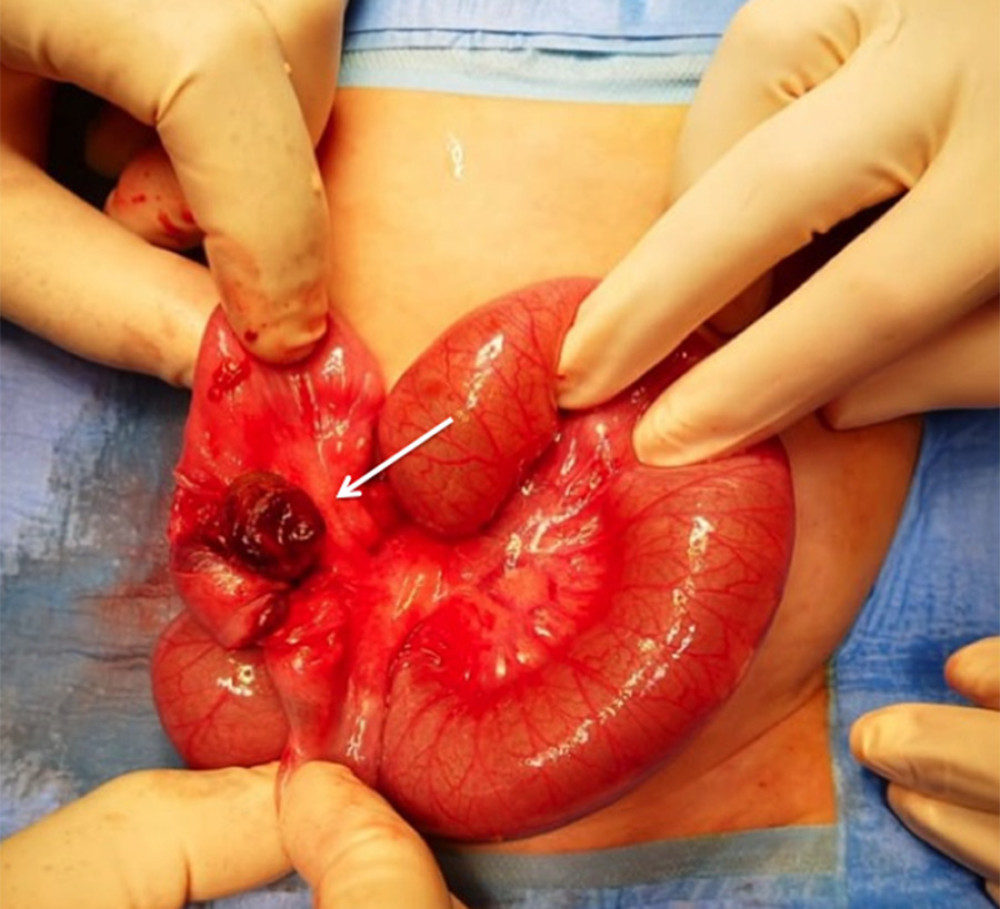 Intra-operative appearance of the ileocecal intussusception with Meckel’s diverticulum acting as a lead point.