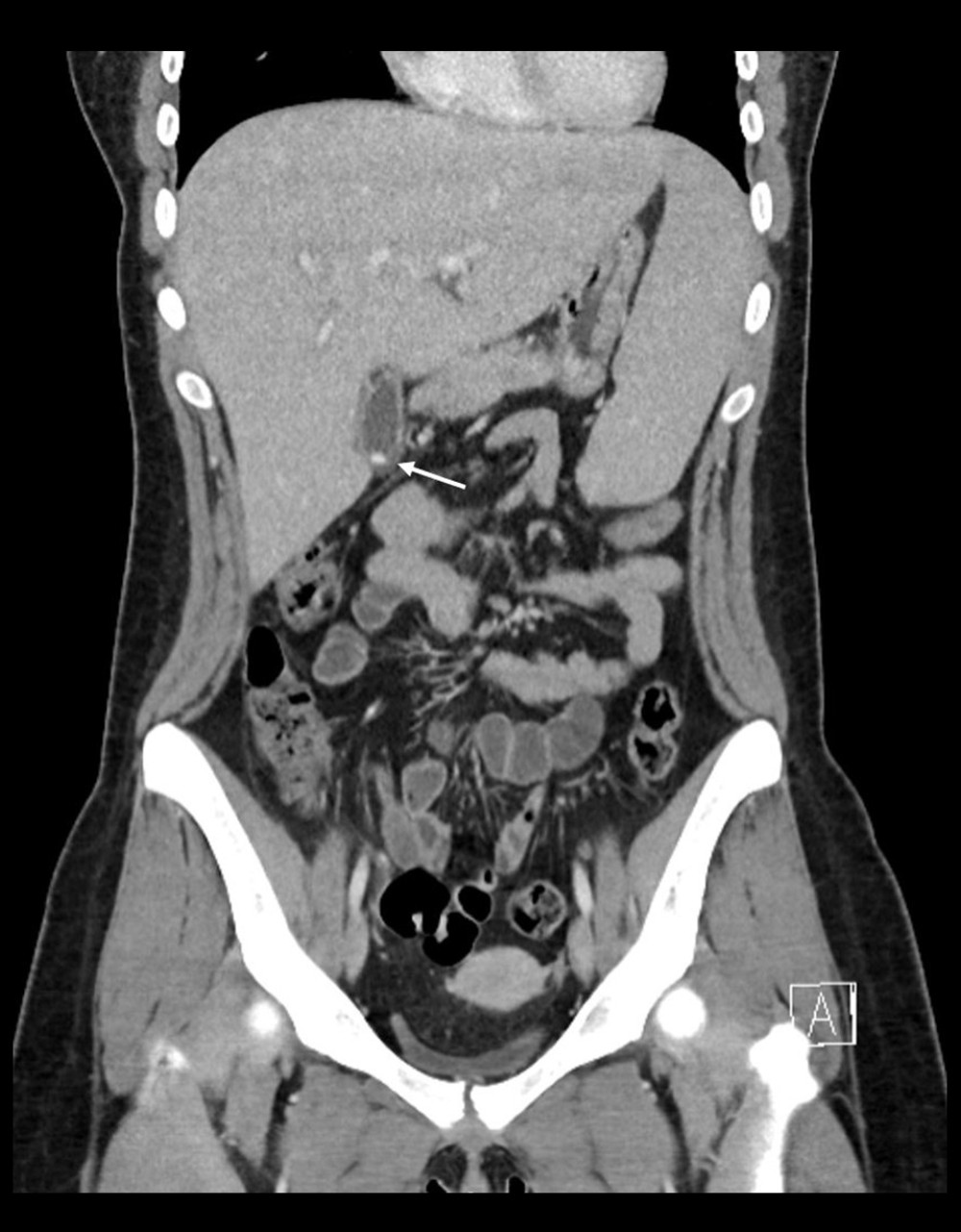 Coronal multiplanar reformat (MPR) from a CT abdomen and pelvis with intravenous contrast, demonstrates splenomegaly with a craniocaudal dimension of 15 cm and mild hepatomegaly with a craniocaudal dimension of 21 cm. In addition, there is a single small gall stone demonstrated (arrow). Appendix was absent.