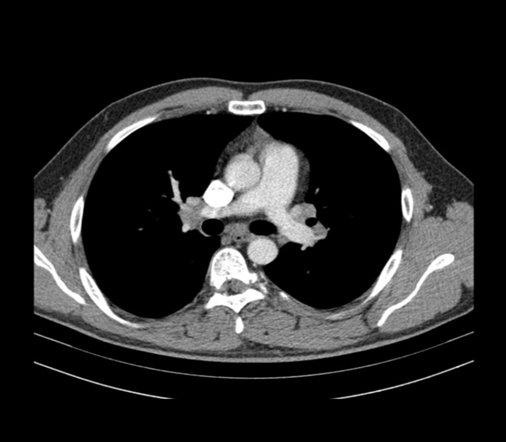 CT scan showing mediastinal lymphadenopathy at the time of diagnostic mediastinoscopy.