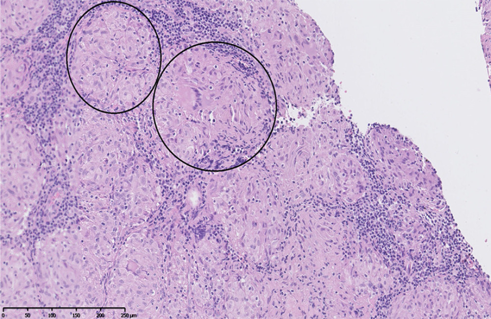 High-magnification, H&E-stained micrograph of a biopsy of the mediastinal lymph node (mediastinoscopy). Multiple, well-formed granulomas consisting predominantly of epithelioid cells, giant cells with a peripheral rim of inflammatory cells, and fibrosis.