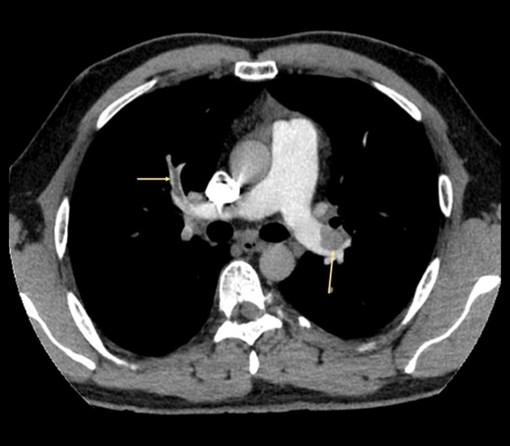 CT scan showing pulmonary embolism (yellow arrow).