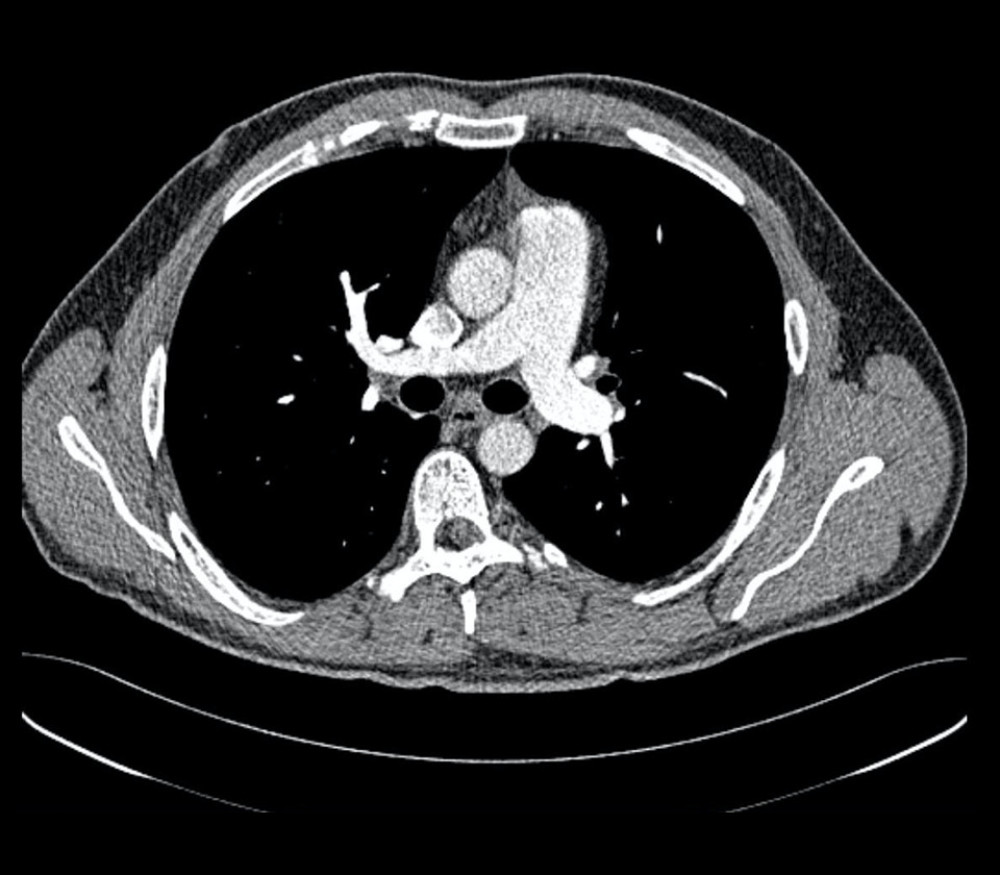 One-year followup after pulmonary embolism was discovered: CT scan.