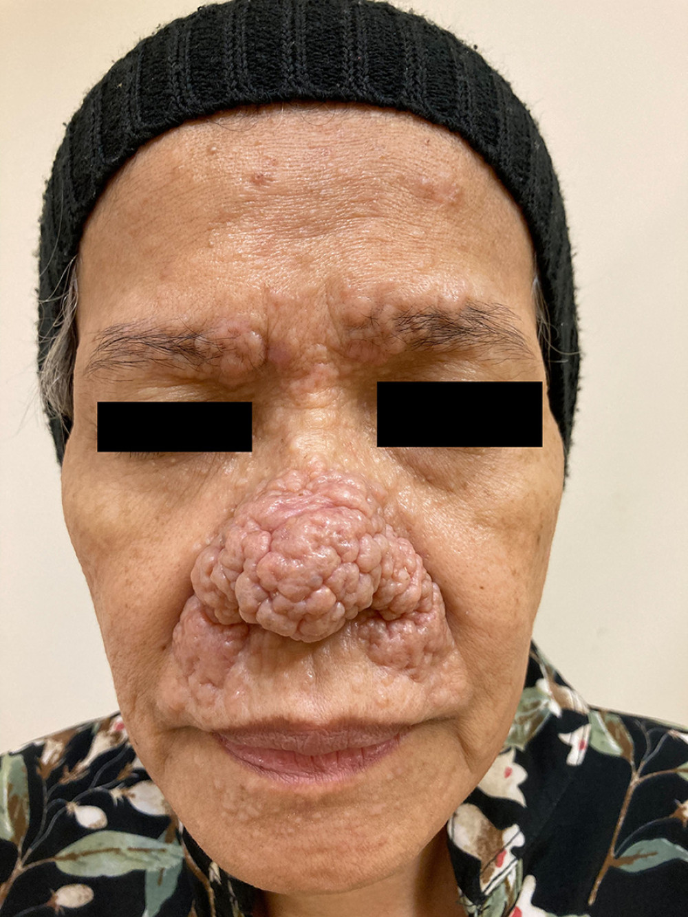 Multiple rounded whitish and skin-colored papules and nodules symmetrically distributed on the nasal and perinasal areas, eyebrows, and forehead.