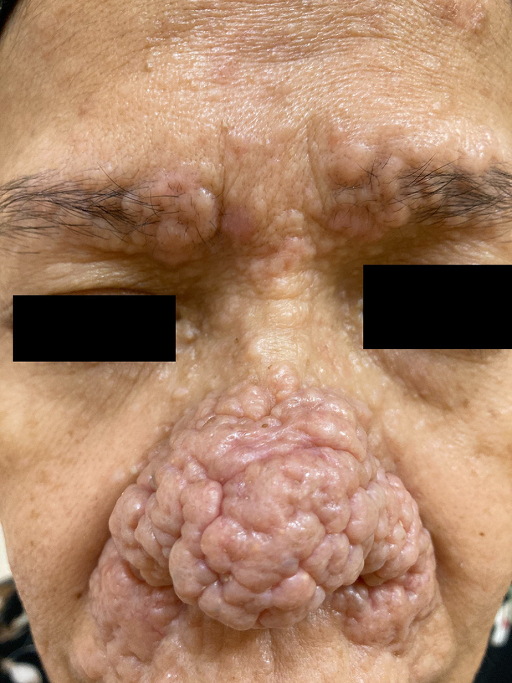 Closer view of multiple rounded whitish and skin-colored papules and nodules on the nasal and perinasal areas, eyebrows, and forehead.