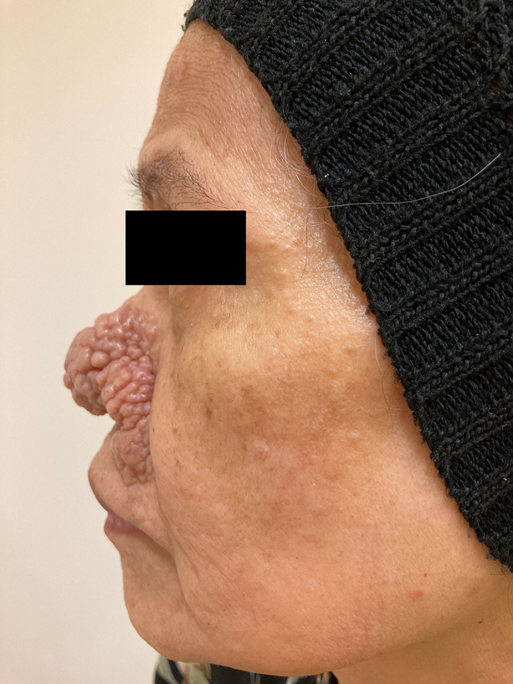 Numerous skin-colored papules on the left side of the patient’s face, most prominent on the nose.