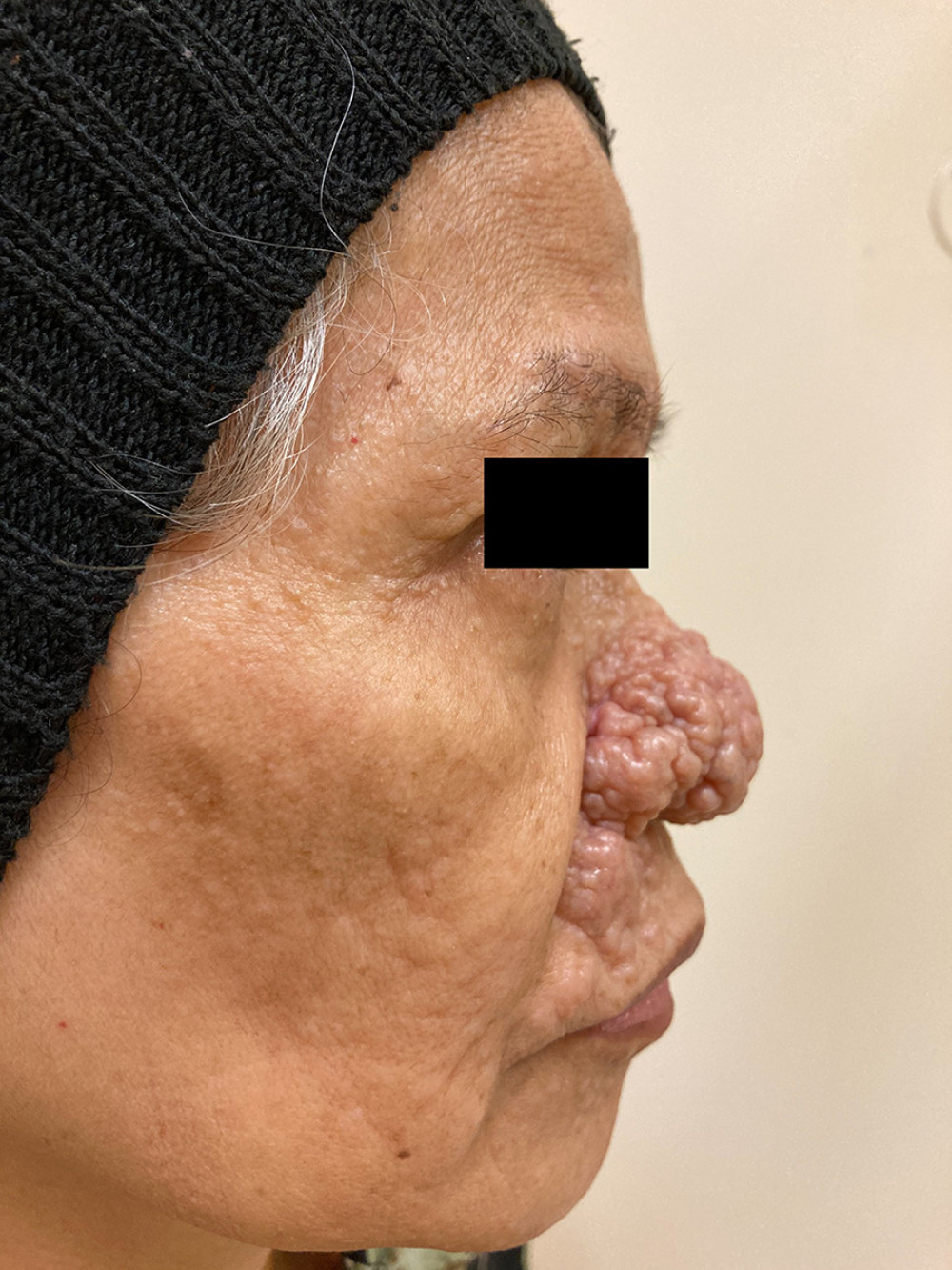 Numerous skin-colored papules on the right side of the patient’s face, most prominent on the nose.
