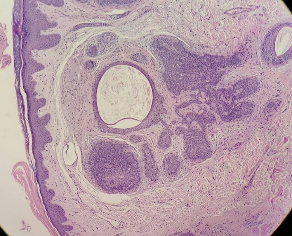 Photomicrograph of H&E-stained section showing well-circumscribed dermal nests of basaloid cells, with peripheral palisading, and keratin horn cysts surrounded by a dense fibrous stroma (4×).