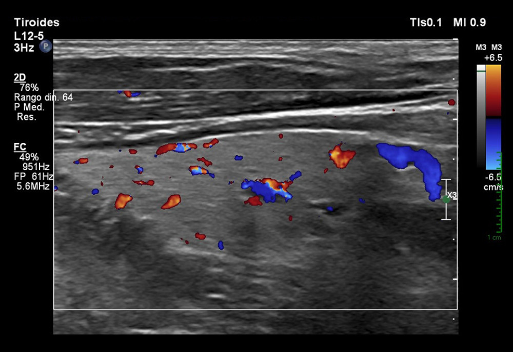 Thyroid ultrasound. The thyroid gland is slightly enlarged. Thyroid tissue is heterogeneous with multiple hypoechoic micronodular areas. Vascularity is diffusely increased.