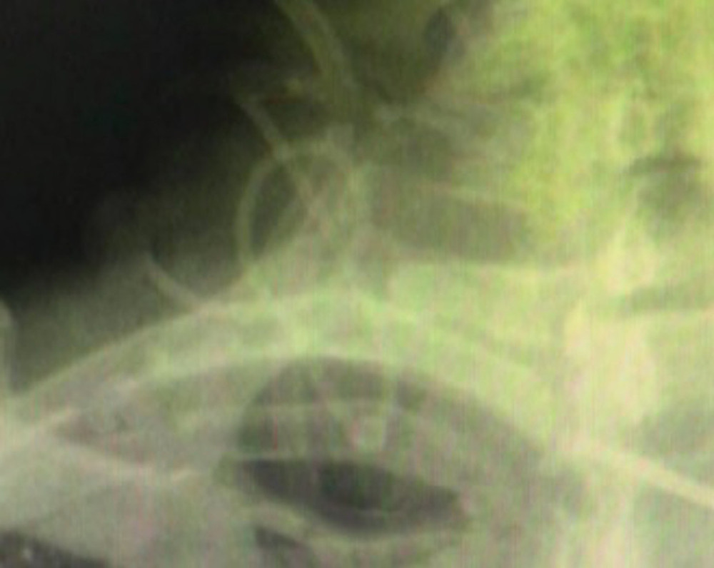 Enlarged chest X-ray, after an immediate attempt to remove catheter, suggesting a knot in the catheter, in addition to loop formation.