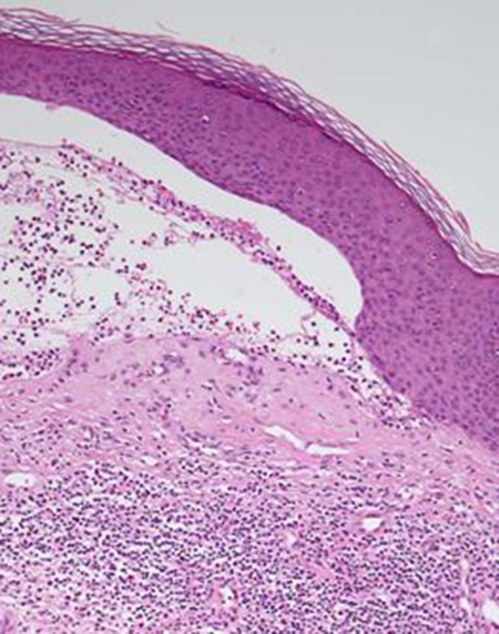 Subepidermal blister along with underlying polymorphous infiltrate, mainly of an eosinophilic profile.