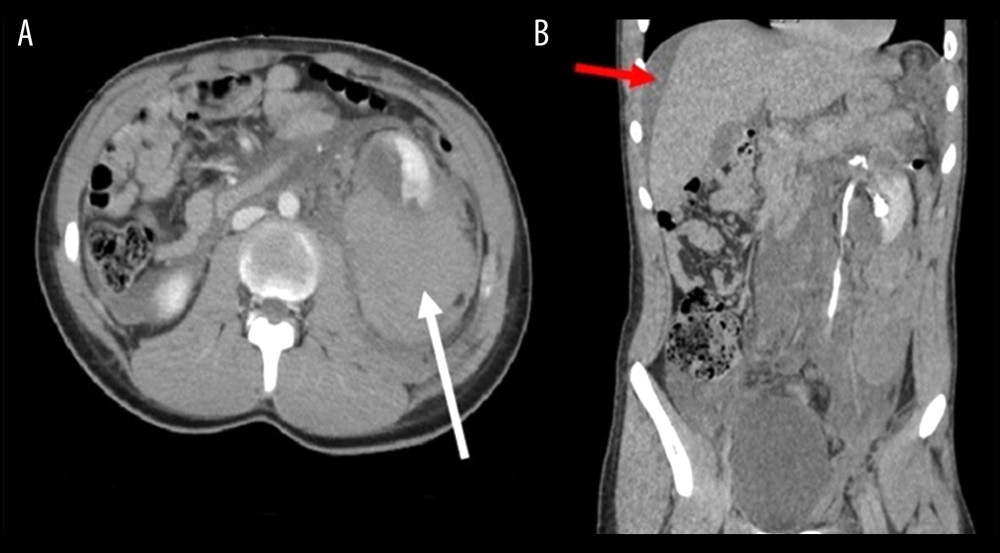 Computed tomography angiography scans of the patient in Case 1. The axial view (A) shows a large left perinephric hematoma (white arrow). The coronal view (B) shows the full extent of the left retroperitoneal hematoma, as well as hemoperitoneum, as evidenced by the perihepatic free fluid (red arrow).