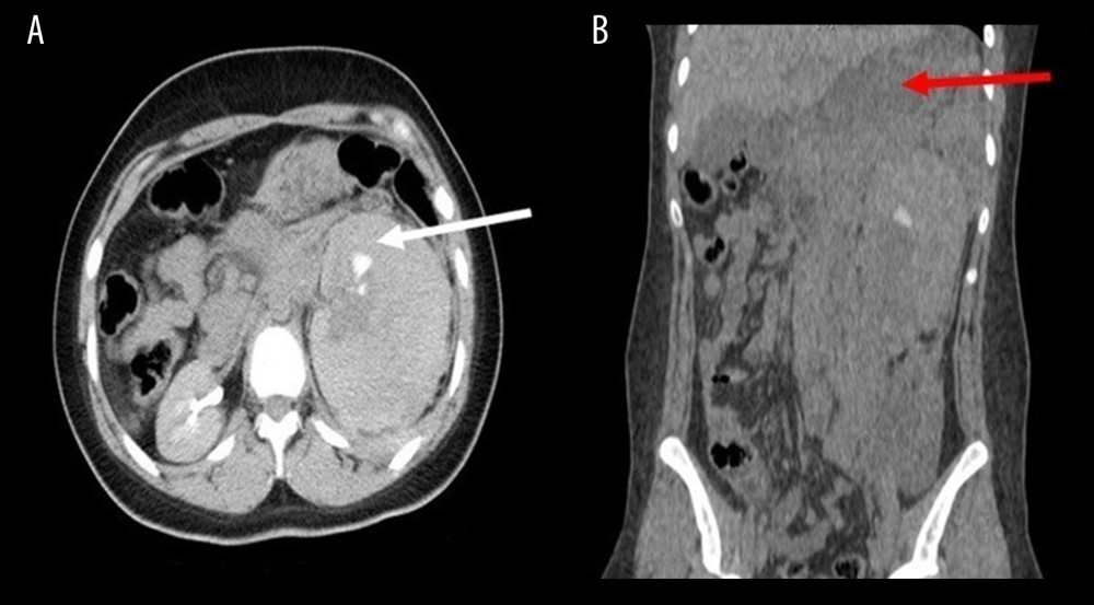 Contrast-enhanced computed tomography scans of the patient in Case 2. The axial view (A) shows devascularization of the left kidney, except for a small segment that is likely supplied by an accessory branch (white arrow). The coronal view (B) shows the full extent of the left retroperitoneal hematoma, with hemoperitoneum across the upper abdomen (red arrow) Note: This finding correlates with the patient’s positive focused assessment with sonography in trauma exam in the splenorenal window on arrival.