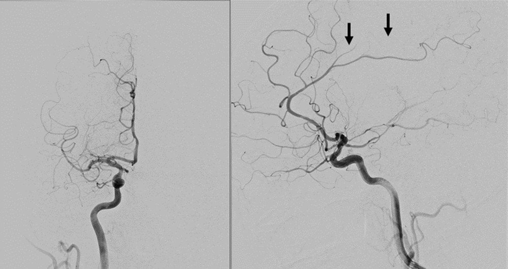 Angiographic images of the right internal carotid artery (ICA) on the anteroposterior and lateral views revealed segmental occlusion of the posterior division of the right middle cerebral artery (M2 segment). Distal occlusion of the few of cortical branches of the right anterior cerebral artery (ACA) was also observed (black arrows).