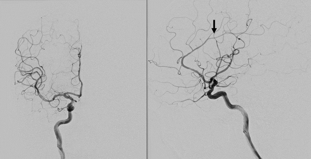 Angiographic images of the right ICA on AP and lateral views after endovascular thrombectomy, showing complete opacification of the posterior division of the right MCA (M2 segment), but distal occlusion of the right ACA cortical branches was still observed (black arrow).