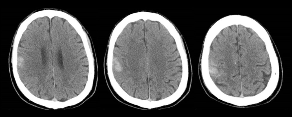 Computed tomography (CT) images of the brain 24 hours after thrombectomy, showing acute intracerebral hemorrhage at the right frontoparietal region, affecting the right pre- and postcentral gyri.