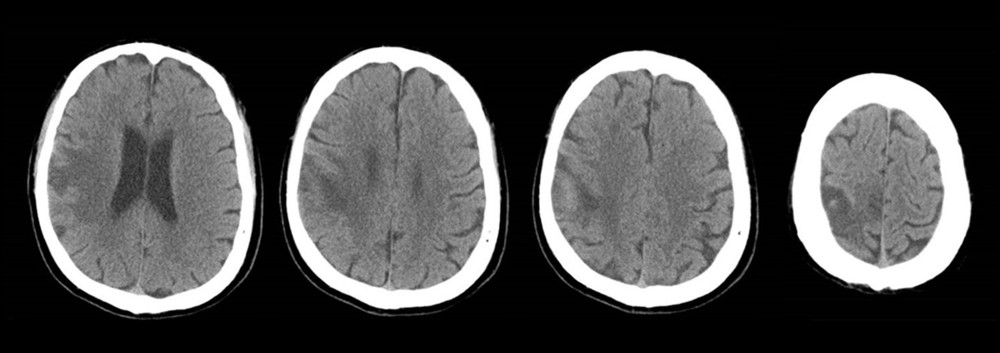 CT brain about 2 weeks after rehabilitation, showing late subacute right MCA’s territorial infarction at the right paracentral lobule, right pre- and (particularly) postcentral gyri, with resolving hemorrhagic transformation.