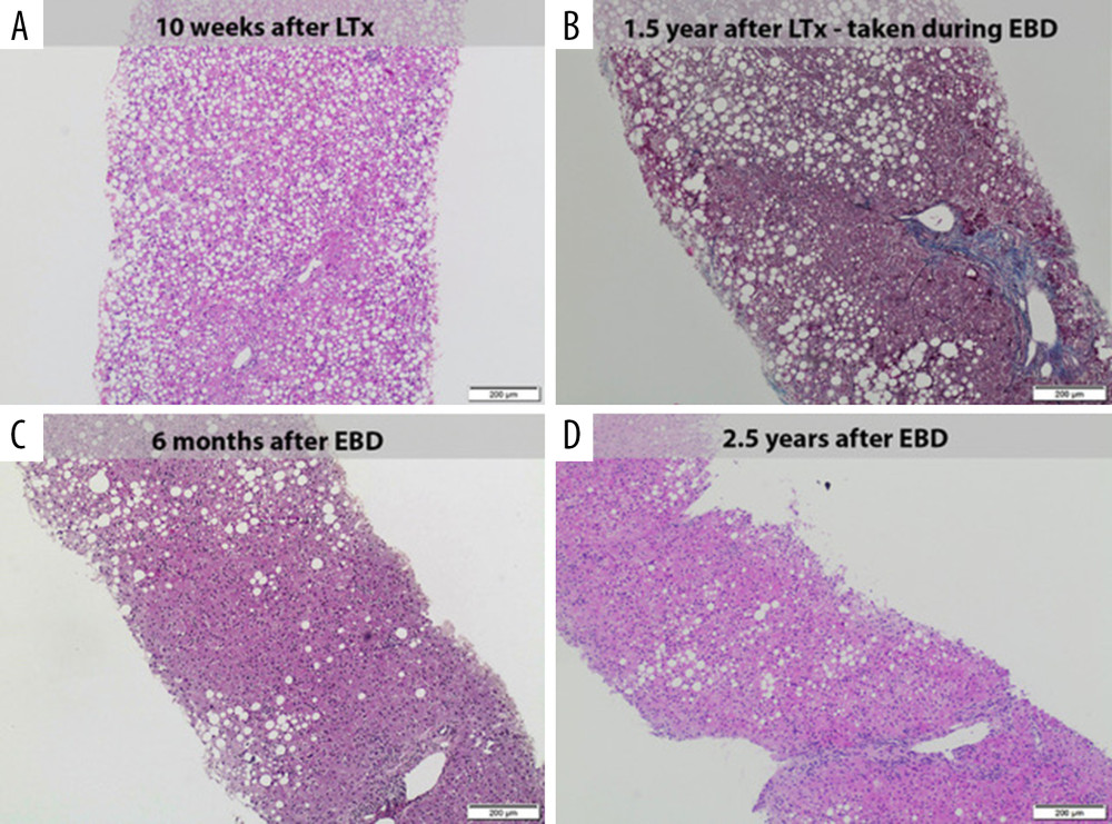 Liver biopsies after LTx – Case 1. (A) Mixed macro- and microvesicular steatosis (95%) and portal tract without fibrosis, without ductular proliferation (H&E staining). (B) Mixed macro- and microvesicular steatosis (70%), portal and periportal fibrosis without ductular proliferation (Azan staining). (C) Mixed macro- and microvesicular steatosis (40%), portal tract without fibrosis, without ductular proliferation, mild inflammatory infiltrates (H&E staining). (D) Mixed macro-and microvesicular steatosis (30%), fibrous septa, and mild inflammatory filtrates (H&E staining).