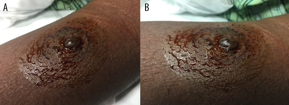 (A, B) Loxosceles bite site on the anterior portion of patient’s left forearm. Photograph taken with patient and parent permission on day 5 of hospitalization.