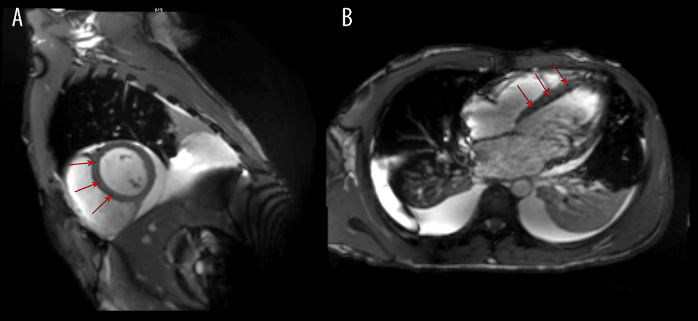 (A, B) Short-axis and long-axis sections from cardiac magnetic resonance imaging showing late gadolinium enhancement in the ventricular myocardium (depicted by red arrows), consistent with diagnosis of myocarditis.