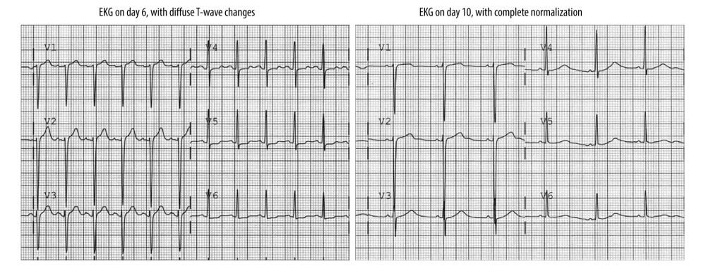 (A) Electrocardiogram (EKG) with T-wave abnormalities on day 6 of admission, and (B) resolution of EKG abnormalities after initiation of treatment for myocarditis.